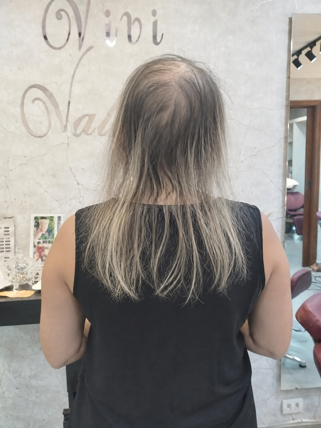 Antes: cabelo com rarefação intensa e couro cabeludo visível