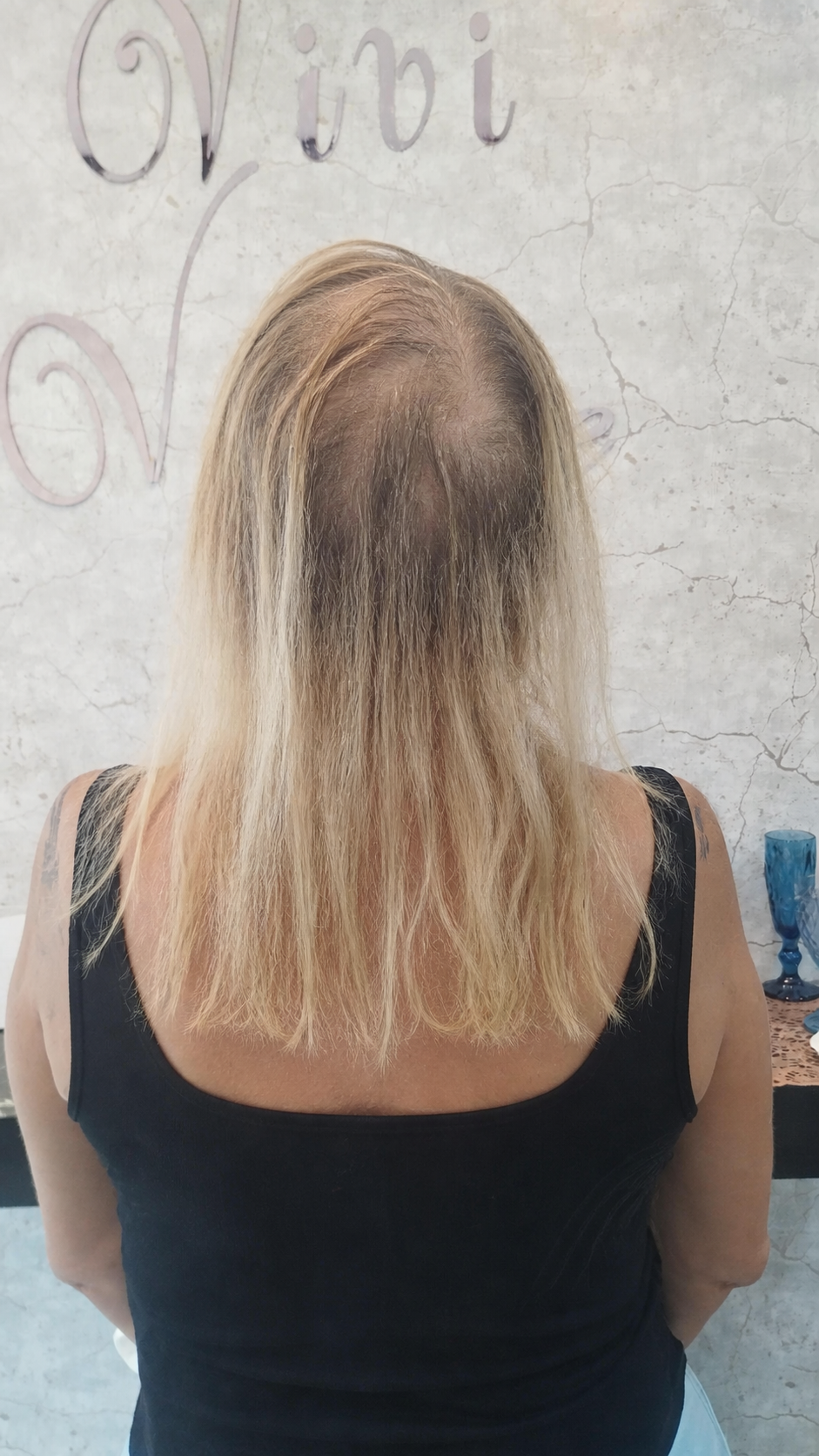 Antes: cabelo loiro ralo, quebradiço e com falhas na coroa
