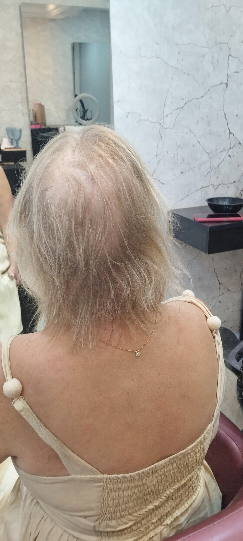 Antes: cabelo claro muito ralo, curto e com couro cabeludo aparente
